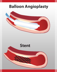 Heart-angioplasty-stent